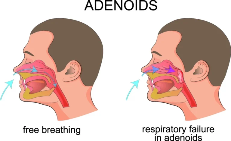 adenoidid